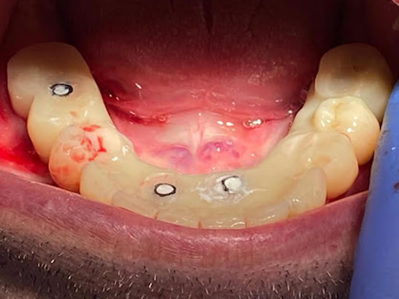 faseoperatoria4