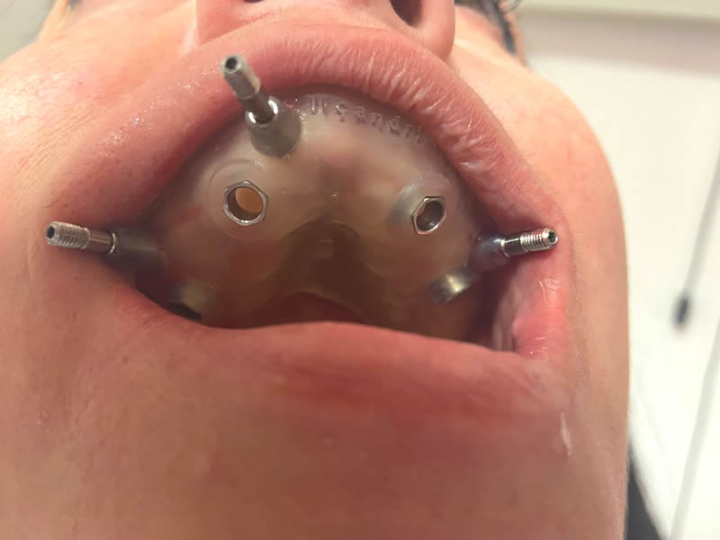 fissaggio-dima-chirurgica-con-pin-laterali