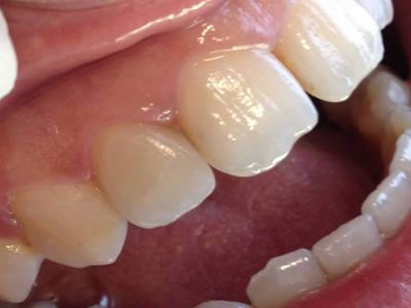 faccette-dentali-estetiche-emax