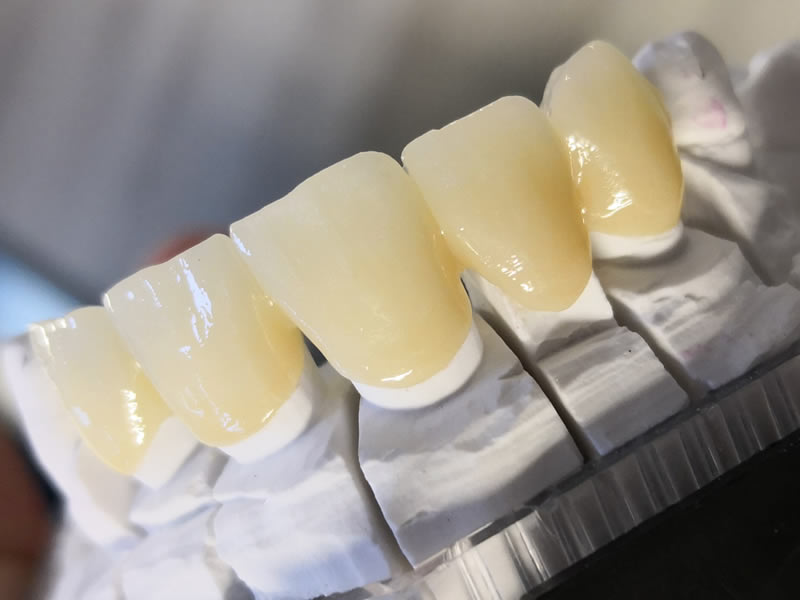 zirconio-5